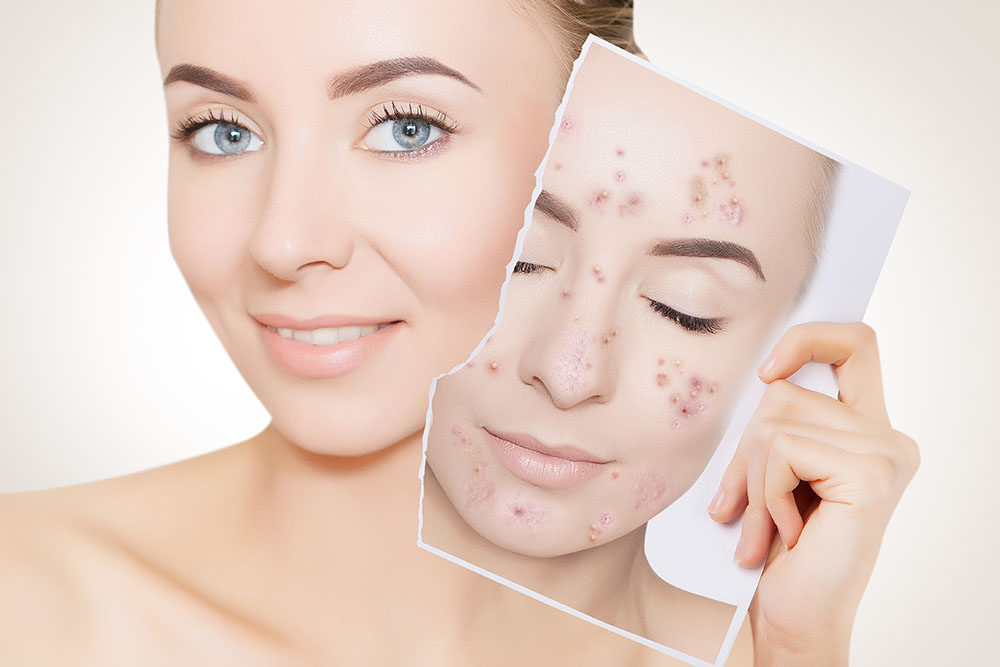 How &#038; Why to Treat Acne
